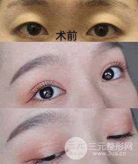 割雙眼皮對(duì)比圖，光看這些圖片就能感受到手術(shù)的優(yōu)勢(shì)