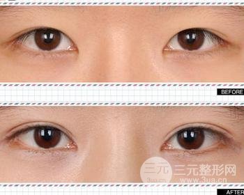 割雙眼皮對(duì)比圖，光看這些圖片就能感受到手術(shù)的優(yōu)勢(shì)