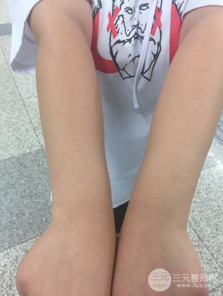 空軍總醫(yī)院激光脫毛半個月