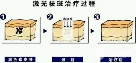 南通中醫(yī)院美容科祛斑技術(shù)原理
