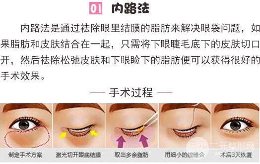 內(nèi)路去眼袋多久能恢復(fù)？適合哪些人群做？