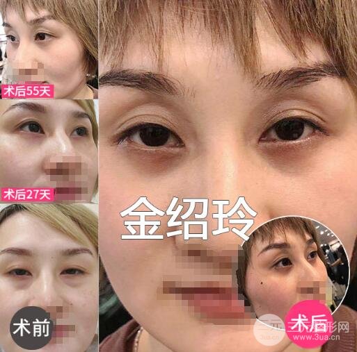 內(nèi)路去眼袋多久能恢復(fù)？適合哪些人群做？