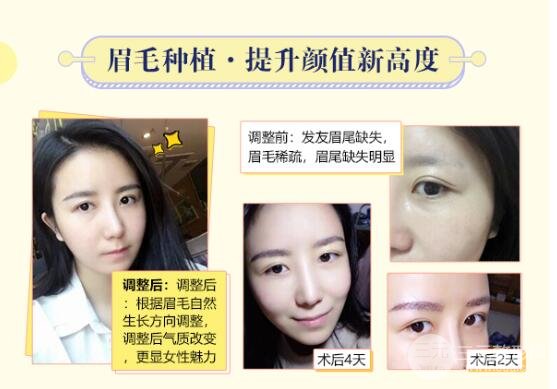 種植眉毛后的注意事項
