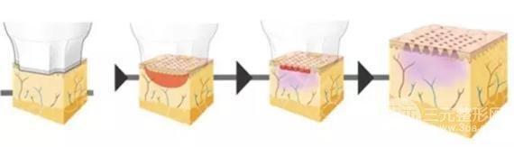 #術(shù)前了解#熱瑪吉除皺能維持多久？果好不好呢？