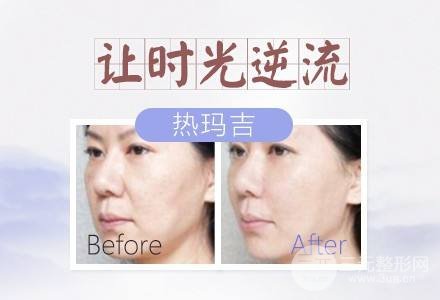 #術(shù)前了解#熱瑪吉除皺能維持多久？果好不好呢？