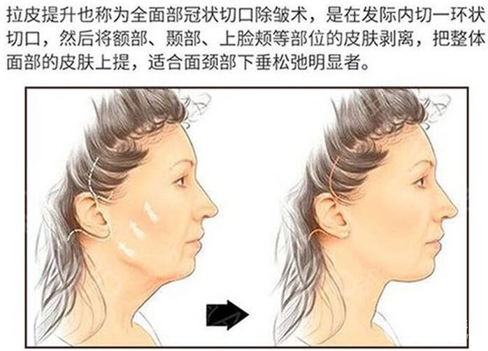 怎么樣去抬頭紋？這個方法才是真·有！