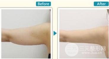 手臂抽脂多少錢？這個(gè)夏日甩掉蝴蝶臂吧~