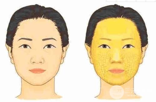 臉部自體脂肪填充價格多少？受到幾點因素影響哦~