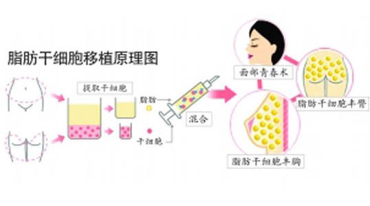 臉部自體脂肪填充價格多少？受到幾點因素影響哦~