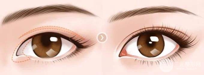 #術(shù)前攻略#韓式開(kāi)內(nèi)眼角多少錢(qián)？看完心里就有數(shù)了~