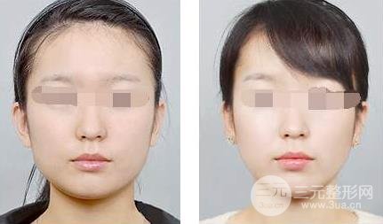 一針改寫命運，10分鐘打造精致小臉，注射瘦臉價格奉上~