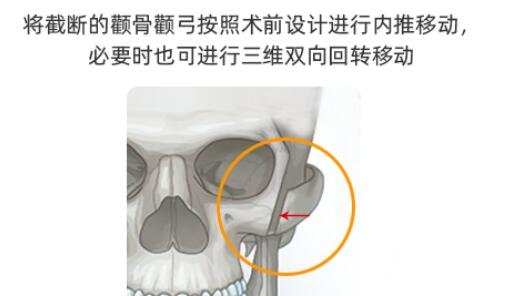 磨骨瘦臉恢復(fù)時(shí)間?