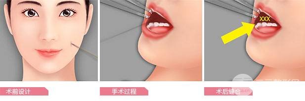 [術(shù)前攻略]酒窩整形價(jià)格是多少，甜美女生必得~