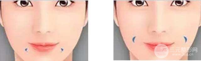 [術(shù)前攻略]酒窩整形價(jià)格是多少，甜美女生必得~