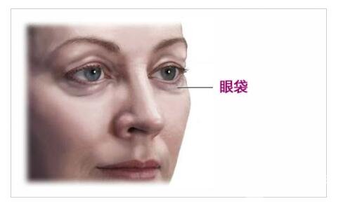 [眼袋走開]內路去眼袋能保持幾年？多久能恢復自然呢？