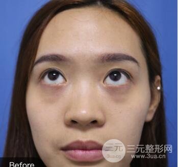 內路去眼袋后的果