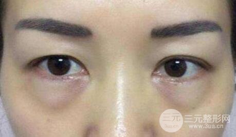 內路去眼袋后注意事項