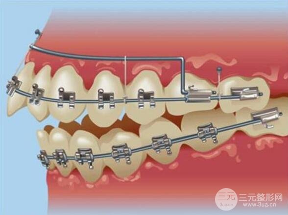 自鎖托槽價(jià)格