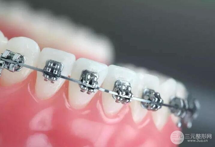 自鎖托槽價(jià)格