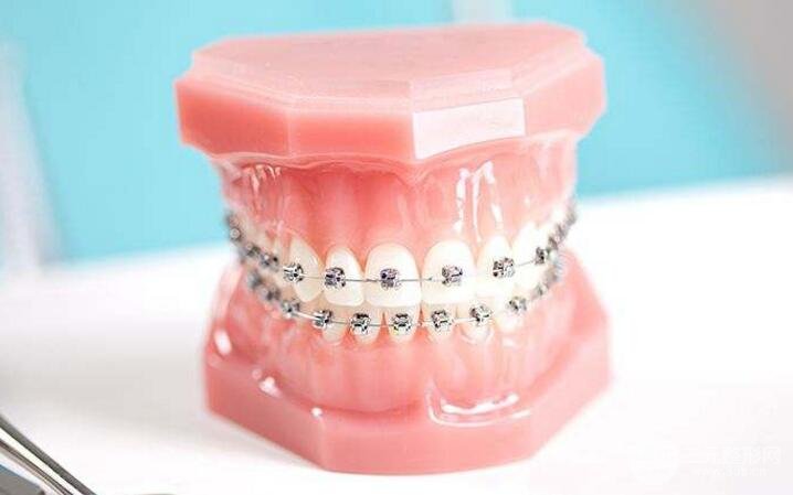 自鎖托槽價(jià)格