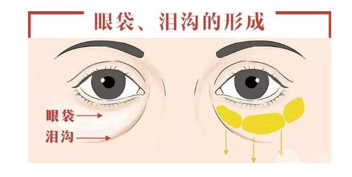 聚能美雕去眼袋多少錢
