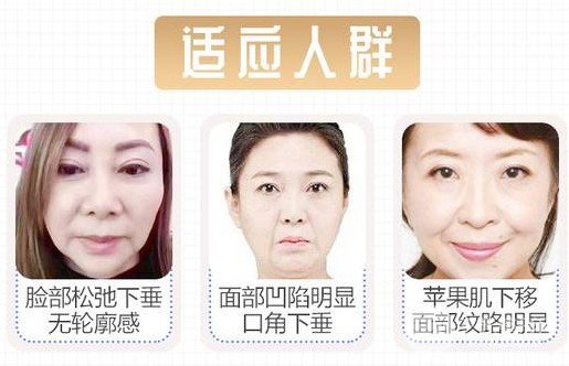 拉皮除皺術(shù)能保持幾年