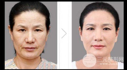 拉皮除皺術(shù)能保持幾年