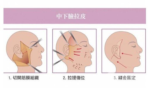 拉皮除皺術(shù)能保持