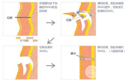 拉皮除皺術(shù)能保持幾年