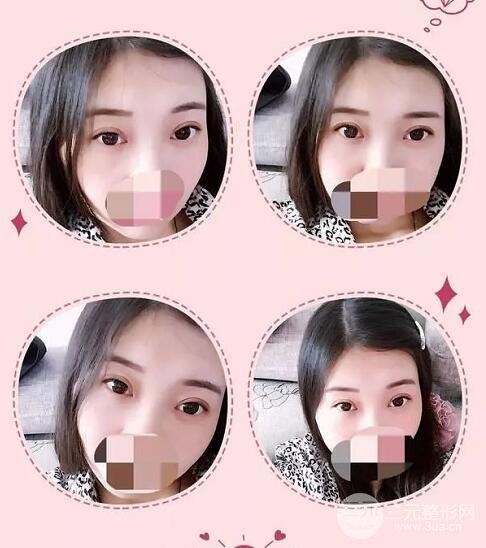 新星靚劉風卓眼修復