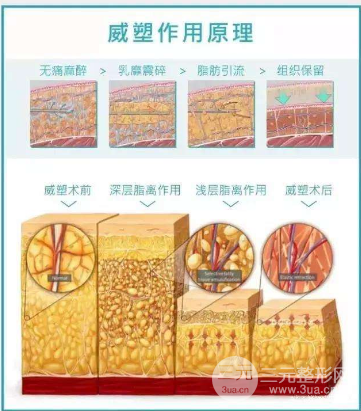 威塑抽脂和水動(dòng)力吸脂區(qū)別