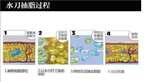 威塑抽脂和水動(dòng)力吸脂區(qū)別