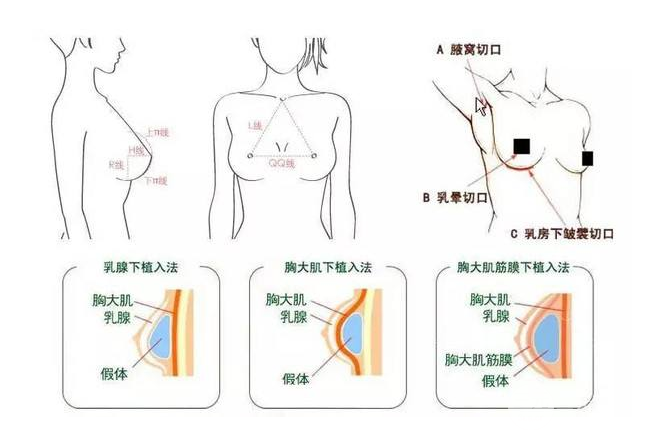 娜綺麗和曼托假體那個(gè)好