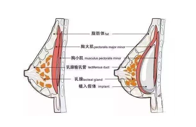 娜綺麗和曼托假體哪個(gè)好