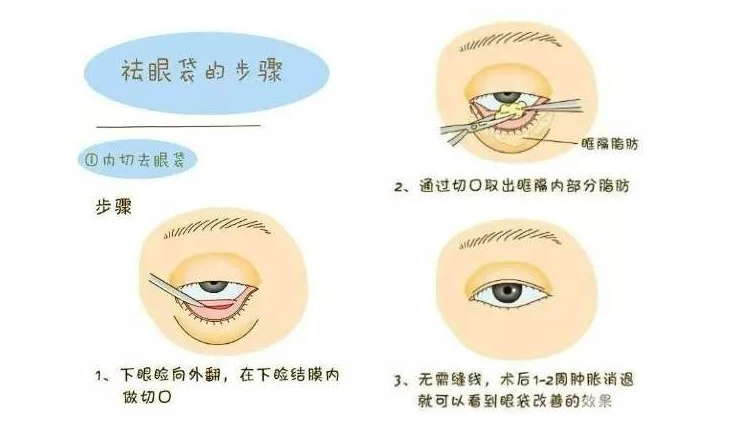 醫(yī)生建議做外切去眼袋的原因！眼下脂肪太多就適合做這個(gè)