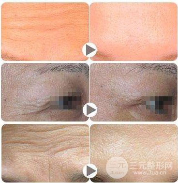 注射****注射瘦臉注意