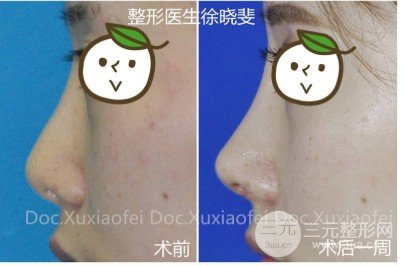 假體隆鼻失敗修復難易程度