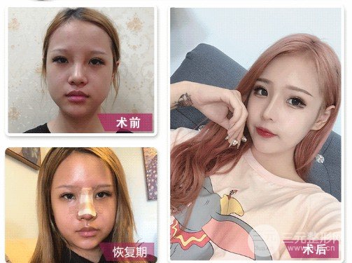 假體隆鼻失敗修復難易程度
