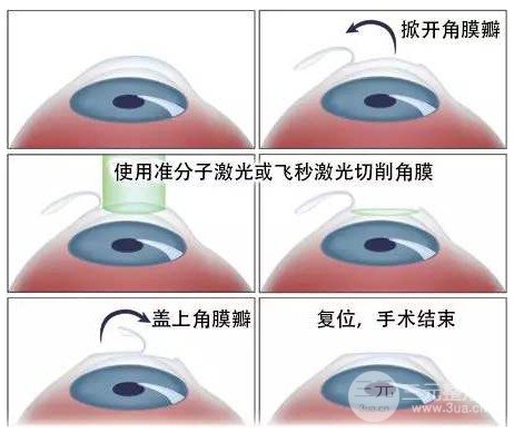 飛秒激光費(fèi)用多少