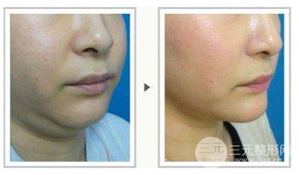 面部吸脂的果怎么樣