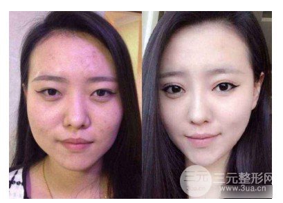 面部吸脂的果怎么樣