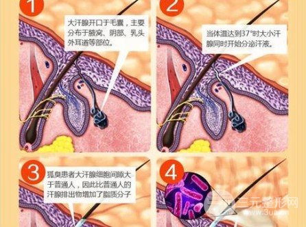 除腋臭手術(shù)有后遺癥嗎