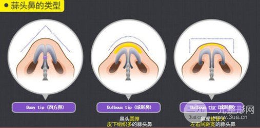 蒜頭鼻整形風(fēng)險大嗎