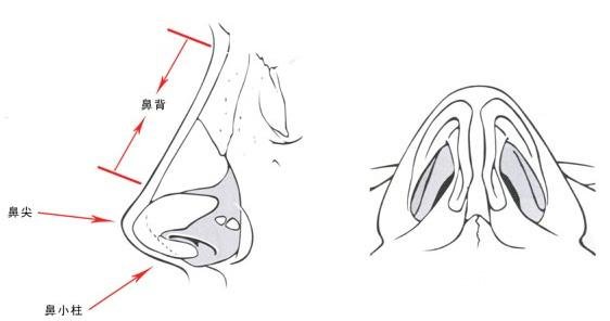 膨體隆鼻后取出