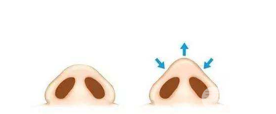 鼻頭縮小術(shù)過程圖