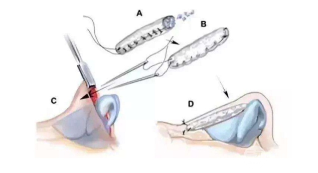 鼻頭縮小術(shù)過程圖