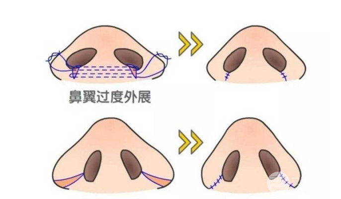 鼻頭縮小術(shù)過程圖