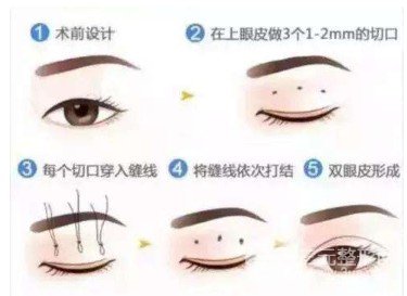 微創(chuàng)定點式好嗎