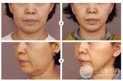 熱瑪吉除皺果多久