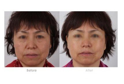 熱瑪吉除皺果多久